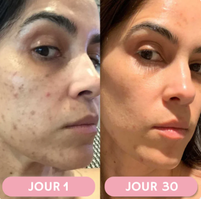 Baguette Haute Fréquence