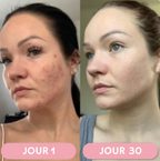 Baguette Haute Fréquence